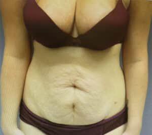 Abdominoplasty