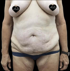 Abdominoplasty