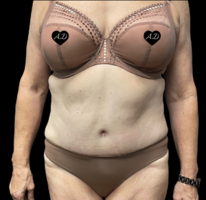 Abdominoplasty